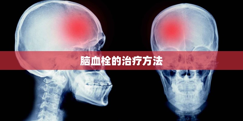 脑血栓的治疗方法